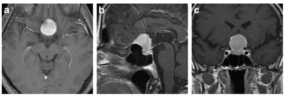 术前MRI