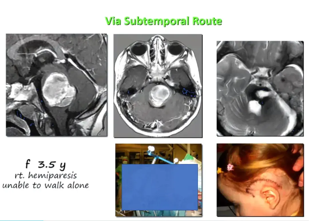 Via Subtemporal Route