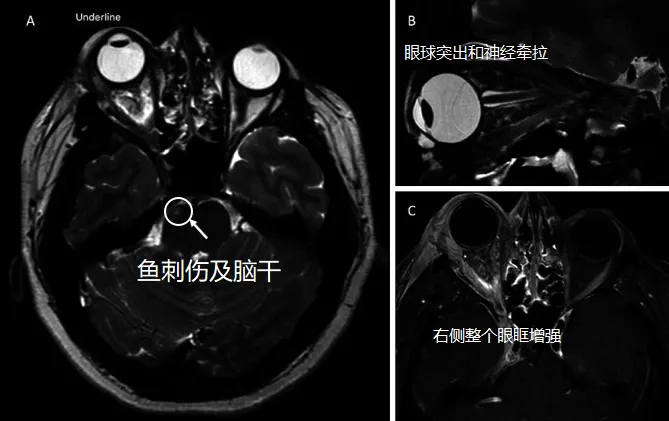 眼球突出和神经牵拉  右侧整个眼眶增强