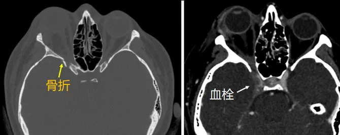一个海绵窦血栓及颈动脉海绵窦瘘，并造成右侧眼眶骨折