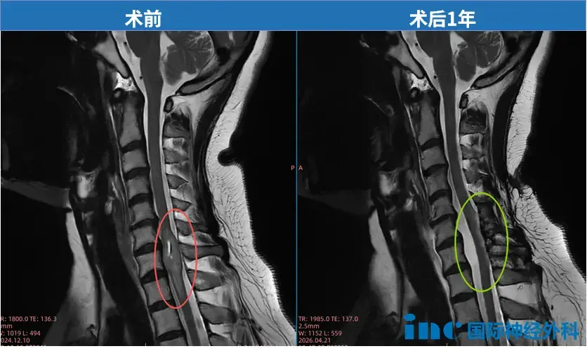术前影像  术后1年影像