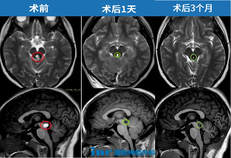 11岁女孩脑干海绵状血管瘤