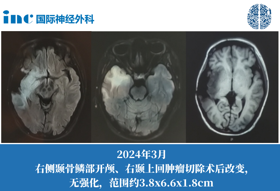 右侧颞叶弥漫性胶质瘤(星形细胞瘤 WHOⅡ级)