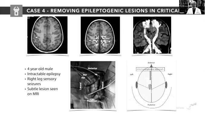 CASE 4- REMOVING EPILEPTOGENIC LESIONS IN CRITICAI