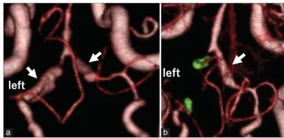 (a) 入院时计算机断层扫描血管造影(后视图)显示双侧椎动脉夹层动脉瘤(箭头所示); (b) 住院第 3 天计算机断层扫描血管造影(后视图,箭头所示);