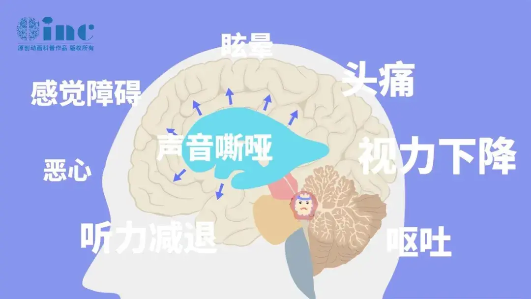 包括听力下降、面瘫、步态不稳、共济失调、三叉神经痛等