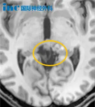 肿瘤大小约26X32X29mm,活检病理为松果体胶质细胞性肿瘤。