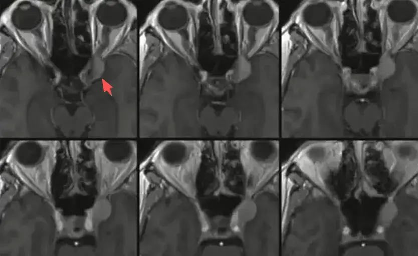 术前MRI