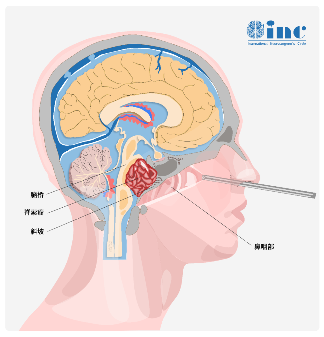 脑瘤手术,选显微镜还是内镜?