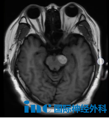 脑干海绵状血管瘤  手术是为了防止再次严重出血