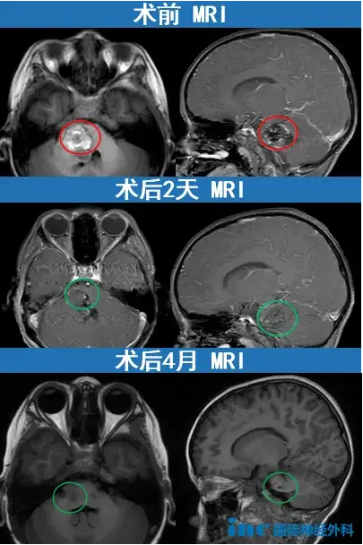 术前术后MRI对比