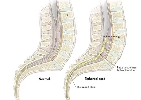 脊髓栓系综合征(Tethered cord syndrome, TCS)。
