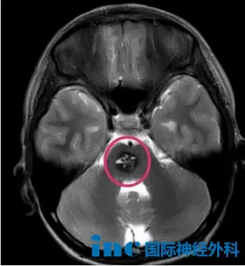 脑干海绵状血管瘤患儿