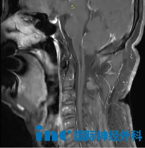 术后最新影像