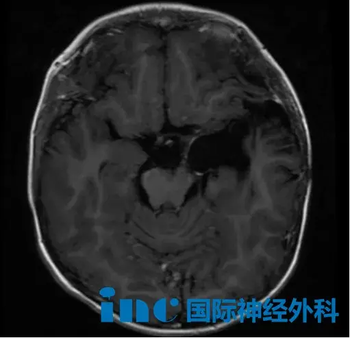 术后最新影像