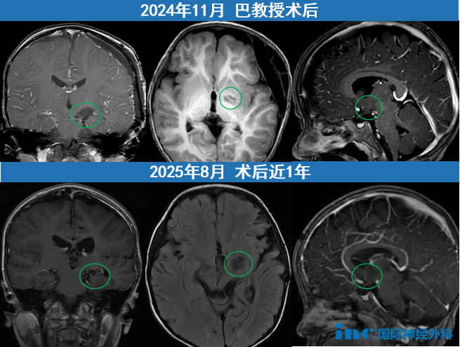 巴教授表示核磁非常好,1年后再随访。肢体活动也恢复得非常好!