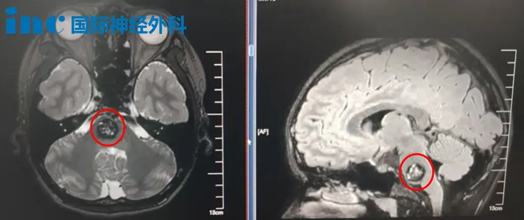 术前MRI