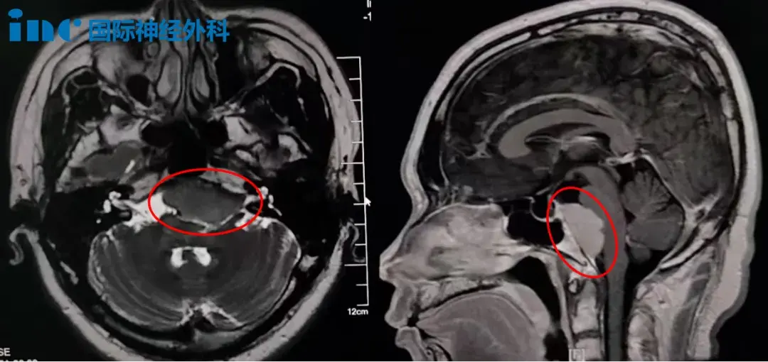 术前MRI