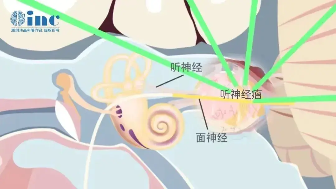 听神经 听神经瘤 面神经