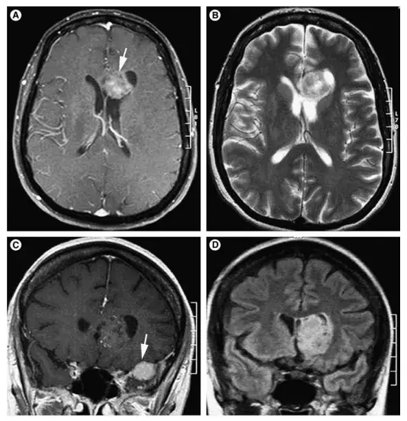 术前MRI