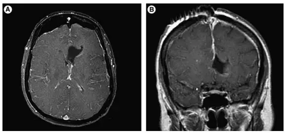 术后MRI