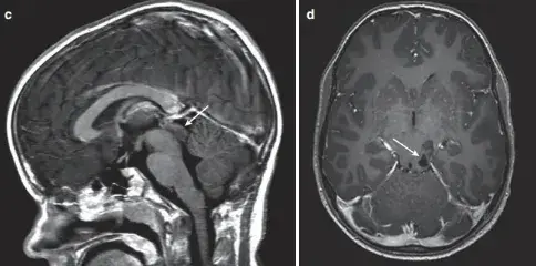 c，后颅窝开颅、肿瘤囊肿引流、囊肿囊被清除后，在MRI 增强（箭头）上仅能看到小的顶盖变形。d，术后增强MRI显示肿瘤起源于顶骨区，无占位效应（箭头）。