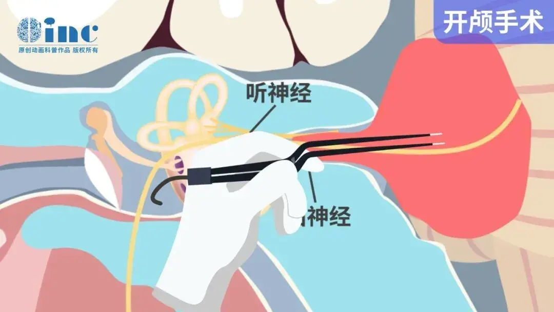 术中“面神经烫伤”是怎么回事？听神经瘤术后面瘫还能恢复吗？