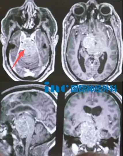 术前MRI