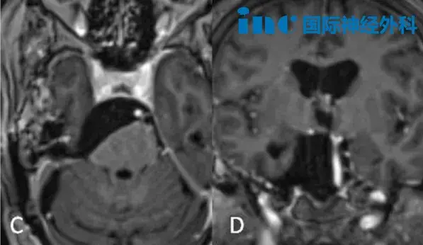 术后MRI