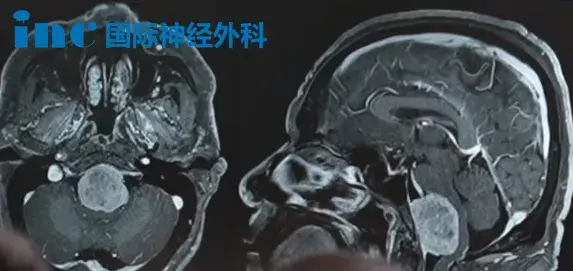 术前MRI