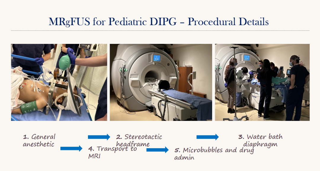 MRgFUS for Pediatric DIPG- Procedural Details