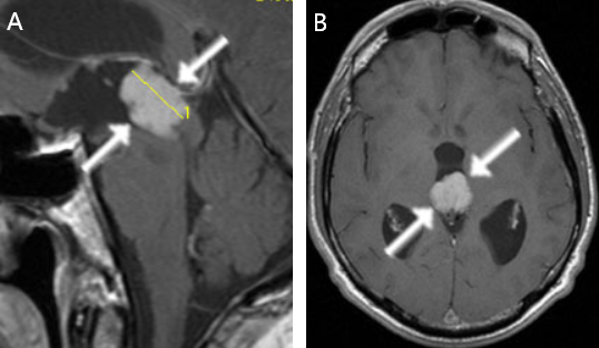 图A：松果体区肿瘤MRI（箭头）。B：核磁共振成像显示脑室扩张（脑积水）。