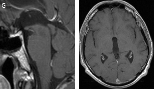 术后MRI，肿瘤全切