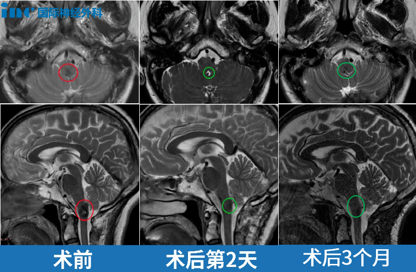 术前术后MRI对比