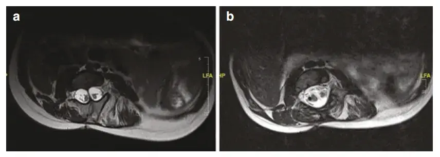 图2 1型SCM的T2加权MRI,显示(a)术前图像,可见骨性骨隔;(b)术后1型SCM,显示骨性骨隔切除后的后方减压。