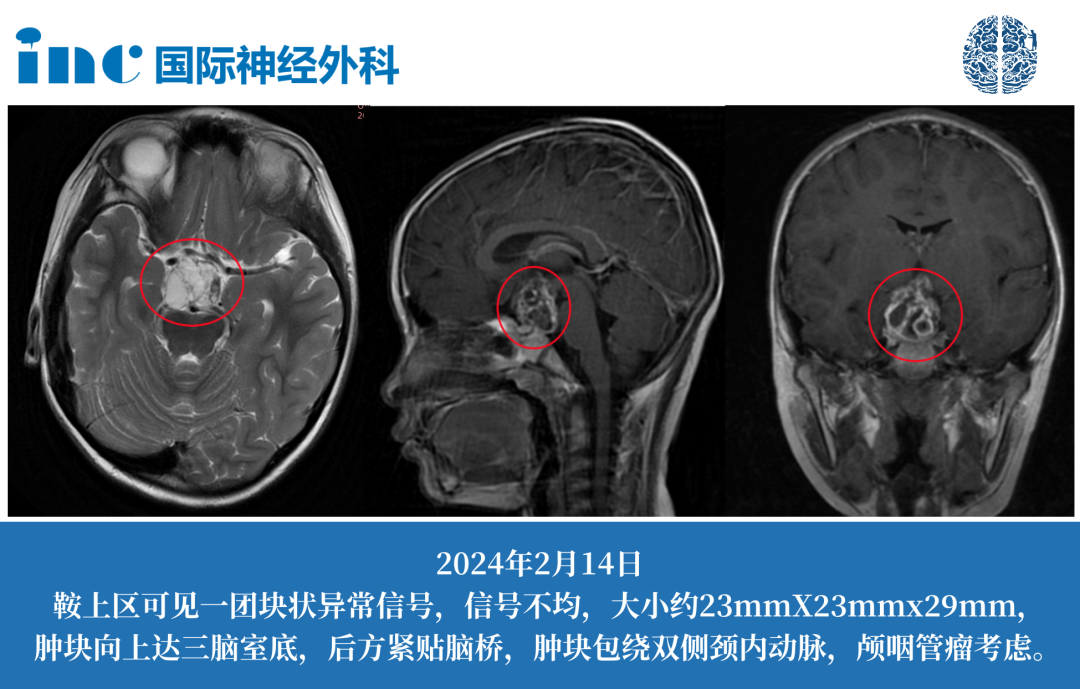 2024年2月14日鞍上区可见一团块状异常信号，信号不均，大小约23mmX23mmx29mm，肿块向上达三脑室底，后方紧贴脑桥，肿块包绕双侧颈内动脉，颅咽管瘤考虑。