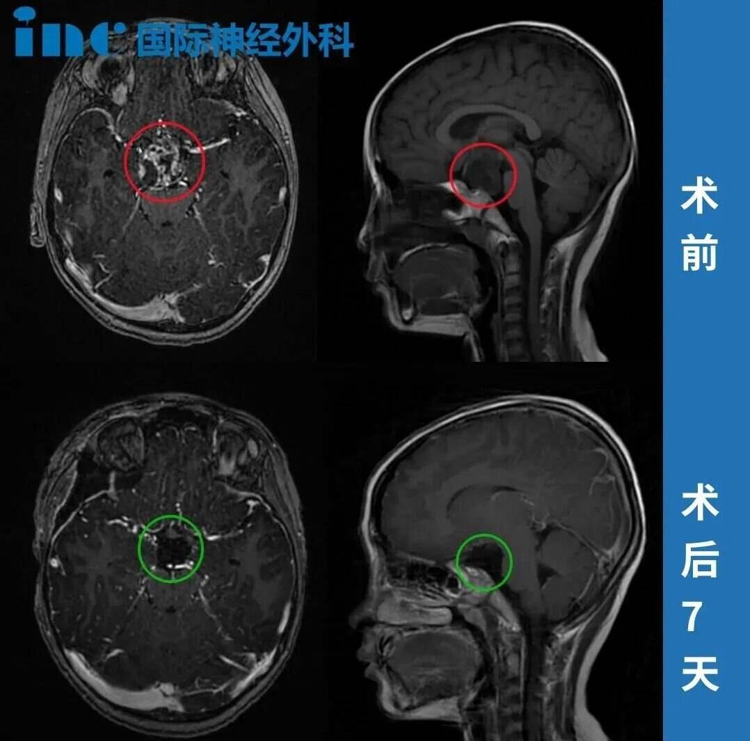 术前术后MRI对比