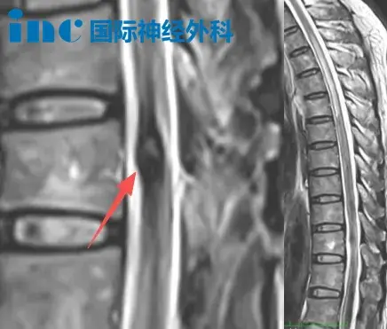 59岁叶先生脊髓髓内占位