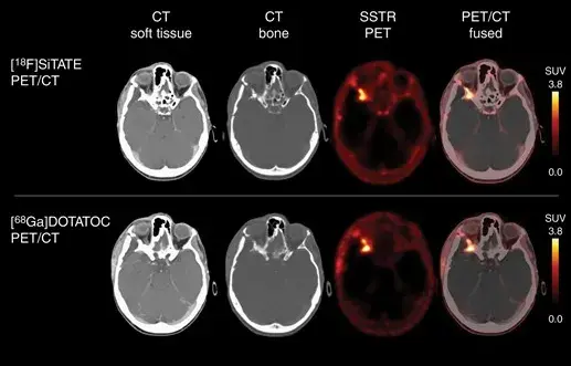 图2:一例WHOI级蝶骨翼脑膜瘤切除术后的18F-SiTATE(上排)和68Ga-DOTATATE PET/CT(下排)显示残留肿瘤位于右侧眼眶外侧。看起来,肿瘤在18F-SiTATE上的摄取与68Ga-DOTATATE PET/CT高度相似。请注意,与18F-SiTATE PET相比,68Ga标记的肽DOTATATE的空间分辨率较低。图自:《Advances in PET imaging for meningioma patients》(doi: 10.1093/noajnl/vdac113. )