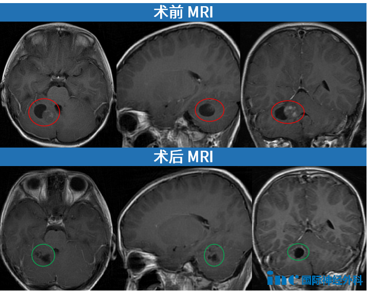 术后病理结果显示，孩子的肿瘤为毛细胞型星形细胞瘤（WHO 1级），一旦全切，预后极好。