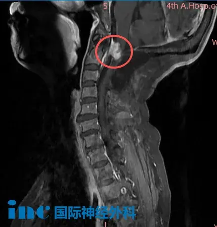 术前MRI