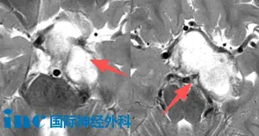 5岁男孩鞍区病变