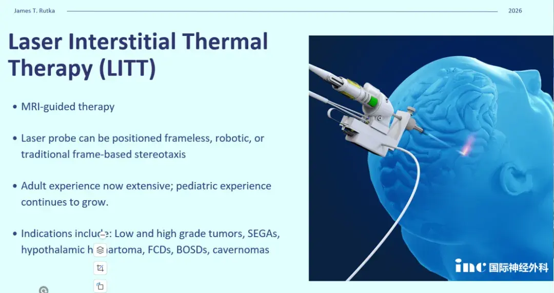 Laser Interstitial Thermal Therapy(LITT)