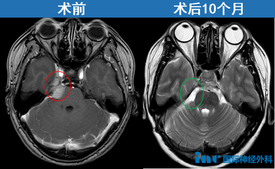桥小脑角(CPA)区脑膜瘤