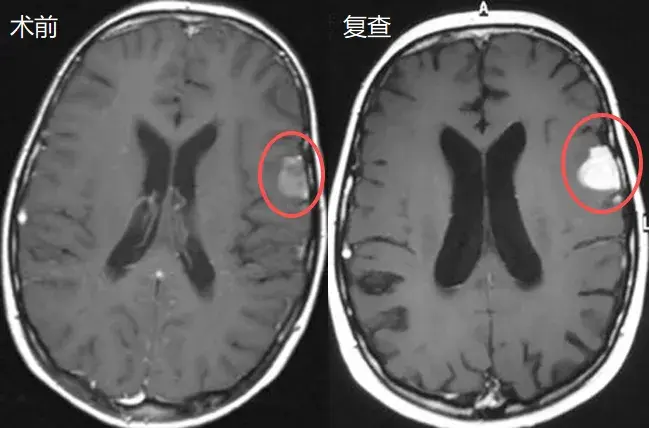 但在2个月后，再次复查竟发现这个额叶的病灶略微增大了。
