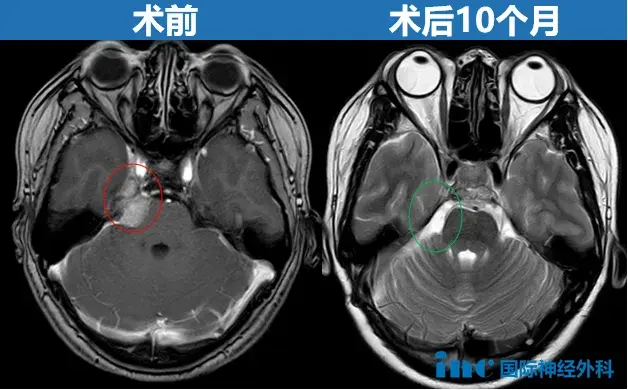 右侧CPA区脑膜瘤术前术后MRI对比,术后10个月复查示肿瘤全切、术区无新发异常信号