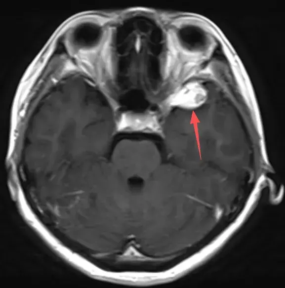 颞叶占位诊断不明,下一步该怎么办?