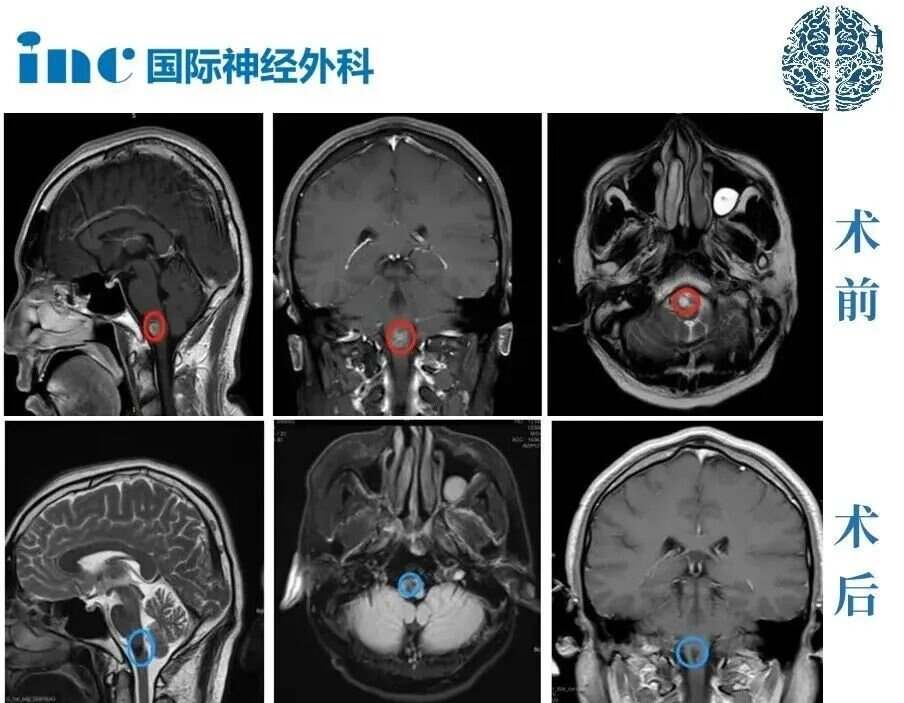 术前 术后