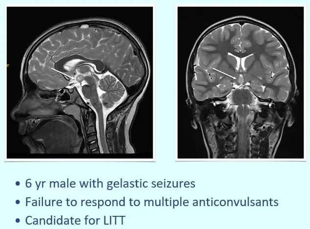 6yrmale with gelastic seizures Failure to respond to multiple anticonvulsants Candidate for LITT