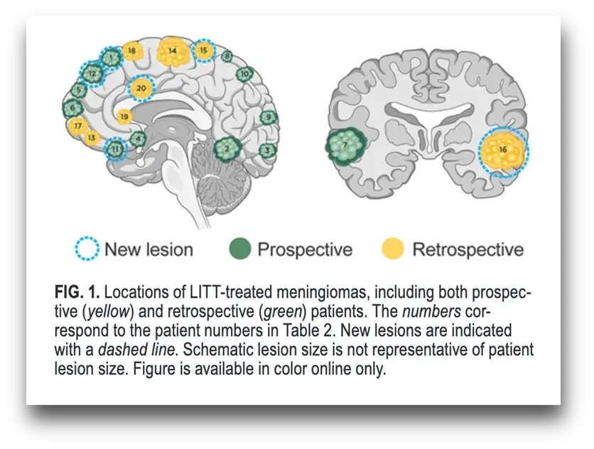 FIG.1. Locations of LITT-treated meningiomas, including both prospective(yellow) and retrospective(green) patients. The numbers correspond to the patient numbers in Table 2. New lesions are indicated with a dashed line. Schematic lesion size is not representative of patient lesion size. Figure is available in color online only.